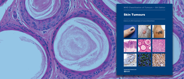 Skin Tumours