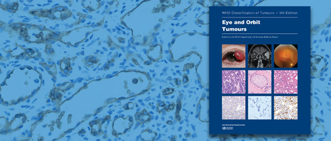 Eye and Orbit Tumours